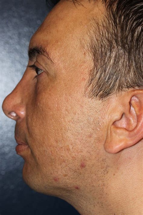 Kybella Nonsurgical Treatment Of Double Chin And Neck Fat