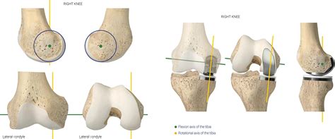 Kinematic Alignment Technique For Unicompartmental Knee Arthroplasty