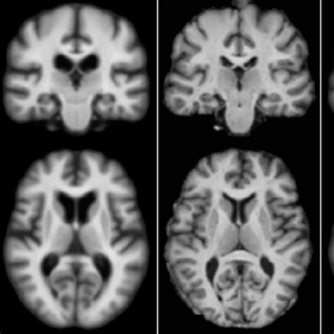 Diffeomorphic Medical Image Registration | Papers With Code