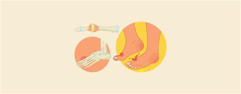 Difference between Gout and Rheumatoid Arthritis: Understanding Two ...