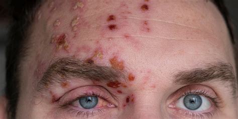 Shingles Symptoms, Causes and Complications | OnlyMyHealth