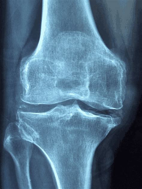 Metabolic Bone Disease - Symptoms, Causes, Diagnosis, Treatment And ...