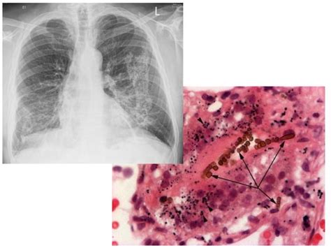 Asbestosis PPT