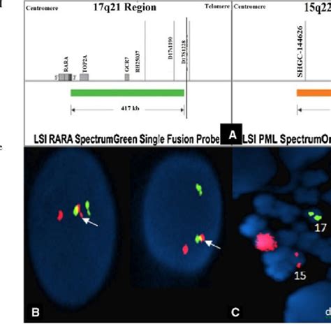 (PDF) A PML/RARA chimeric gene on chromosome 12 in a patient with acute promyelocytic leukemia ...