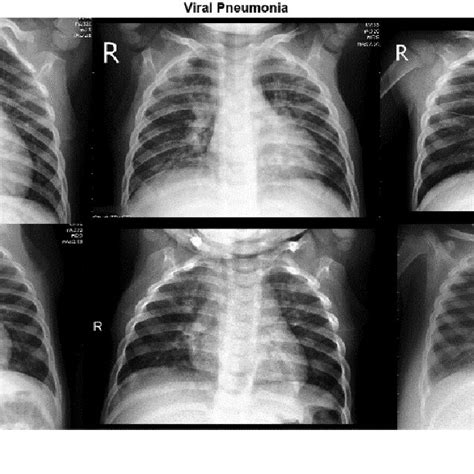 -six random Viral Pneumonia X-ray images | Download Scientific Diagram