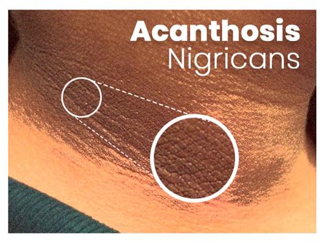 Acanthosis Nigricans Causes Symptoms Risk Factors Diagnosis