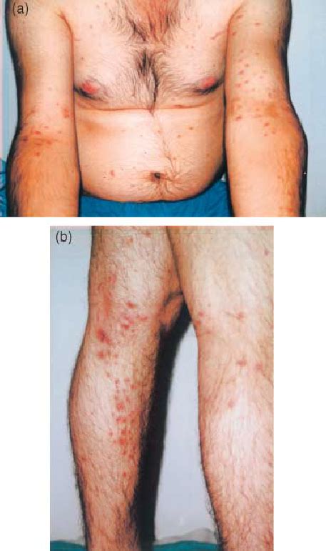 Follicular Erythematous Patches Of Papules And Pustules A On The