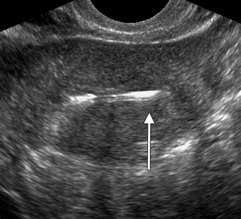 Migration Of Intrauterine Devices Radiologic Findings And Implications For Patient Care