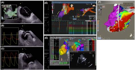 Zero‐fluoroscopy Ablation A The 105 Fr 28 Mm Cryoballoon And The Download Scientific