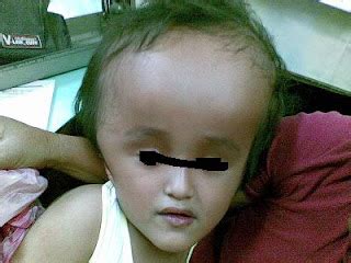 A CASE OF MACROCEPHALY