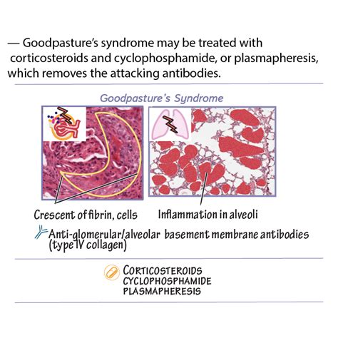 Goodpasture's Disease - Pathology Glossary: Goodpasture’s syndrome | Draw It to Know It