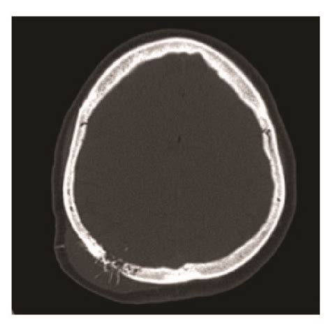 A Preoperative Axial Ct Scan Of The Brain Bone Window Showing