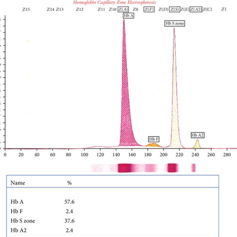 Hemoglobin Electrophoresis Showed The Presence Of 57 6 Hemoglobin A Download Scientific