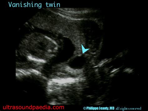 Vanishing twin – ULTRASOUNDPAEDIA