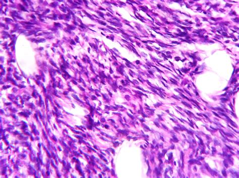 Malignant Phyllodes Tumor Pathology Outlines Bosnianpathology Org