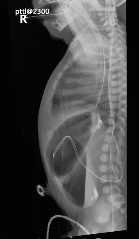 Double Bubble Duodenal Atresia