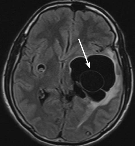 Brain Fluid Attenuated Inversion Recovery Mri Sequence Showing A Download Scientific Diagram