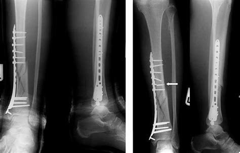 Kevin Ware Injury X Ray