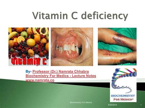 Vitamin C deficiency | PPT