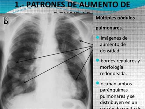 Radiologia De Torax