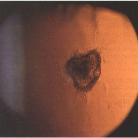 Slit Lamp Views Of Cataracts Showing Early Posterior Subcapsular Lens Download Scientific