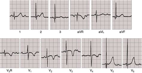 Isolated Congenital Complete Heart Block Thoracic Key