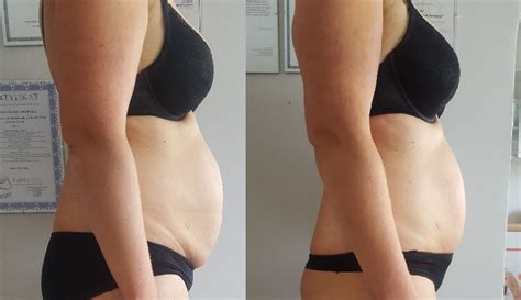 Velashape Before And After Vivalaser For You For All For Beauty