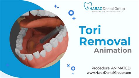 Tori Removal A Guide By Haraz Dental Group Youtube