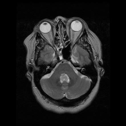 Choroid Plexus Papilloma Image Radiopaedia Org