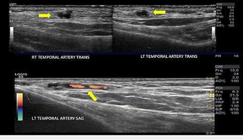 Ultrasound Doppler Of Temporal Arteries Demonstrating Bilateral