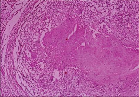 Caseating granuloma: typical epithelioid cell granuloma with central ...