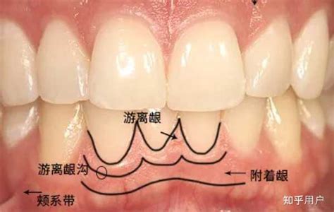 牙龈萎缩可以治愈吗？中医对牙龈萎缩的治疗效果如何呢？ 知乎