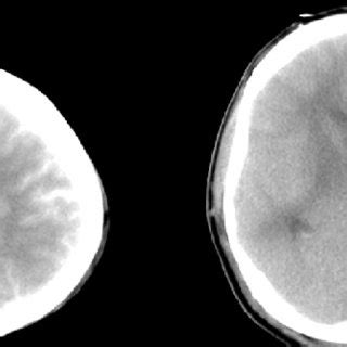 Second Ct One Day After Event Showed Decrease In Brightness Of Contrast