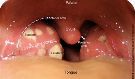 Medical Information About Tonsillitis Causes Symptoms Tests