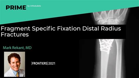 Fragment Specific Fixation Distal Radius Fractures Mark Rekant Md