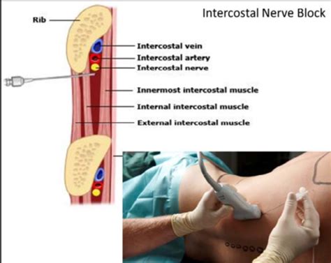 Nerve Body Cavities Clinical Supplement Flashcards Quizlet