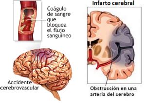 Isquemia Cerebral Cirug A Neurol Gica Mx