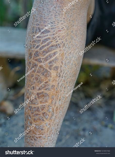 Dry Skin Causes Skin Diseases Winter Stock Photo 1618357360 | Shutterstock