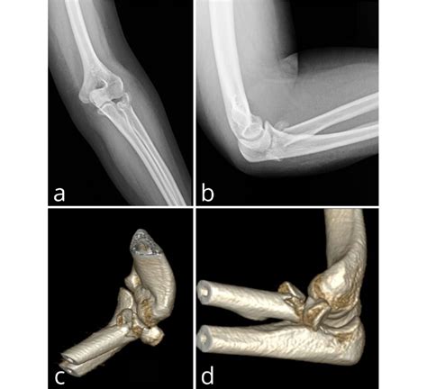 Anteroposterior A And Lateral B X Ray And 3D CT C D Images Of A