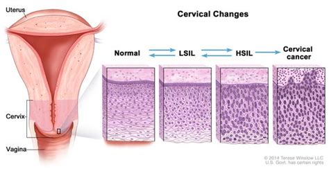 Definition Of Cervical Dysplasia Nci Dictionary Of Cancer Terms Nci