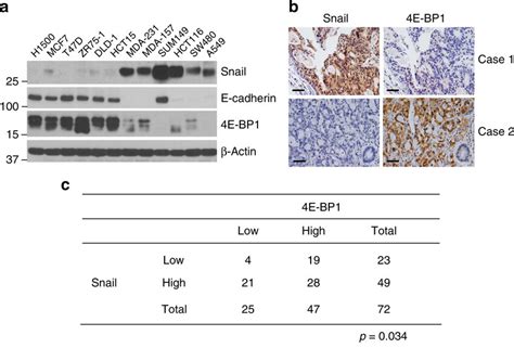 4e Bp1 Expression Inversely Correlates With Snail Expression In Cancer Download Scientific