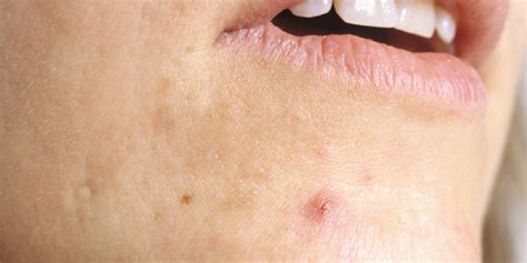 Acne Around Mouth And Chin Pampermy