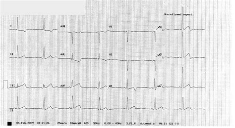 The daily educational pearl – Yamaguchi Cardiomyopathy | Emergucate