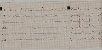 Ivcd ecg measurement - nipodaloha