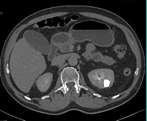 Calcifications In A Calyceal Diverticulum Kidney Case Studies