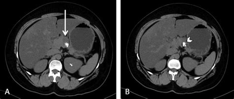 Plain Computed Tomography Of Abdomen Showing A Rounded Homogeneous Download Scientific