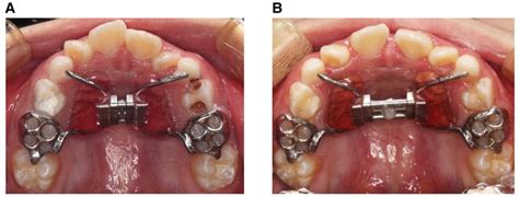 Frontiers Rapid Maxillary Expansion Treatment Increases Mid Facial