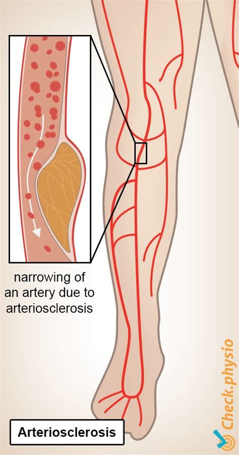 Intermittent Claudication Physio Check