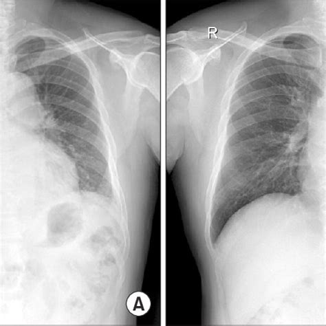 Chest Radiography Images Of The Patient A Initial Chest Radiography