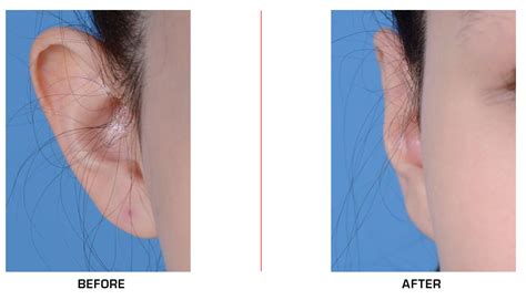 Otoplasty Before And After Gallery